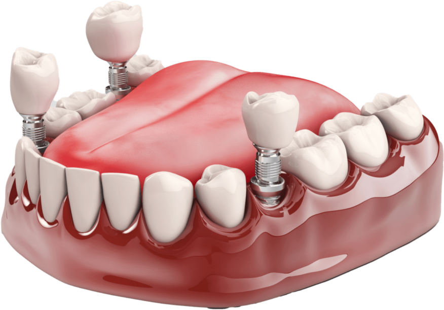 dental implants thumb1