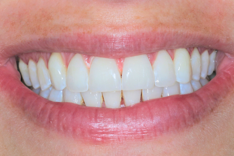 After - The Edge Dental